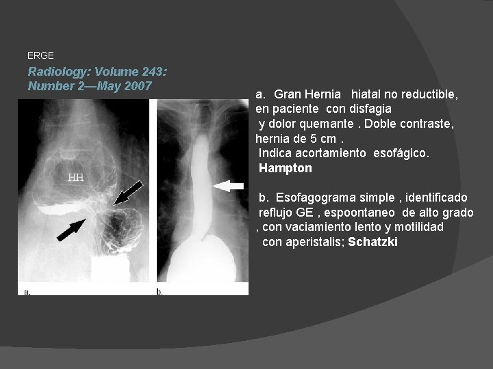 ERGE Radiology: Volume 243: Number 2—May 2007 a. Gran Hernia hiatal no reductible, en
