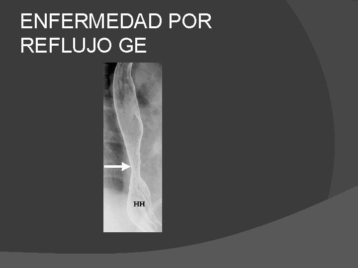 ENFERMEDAD POR REFLUJO GE 
