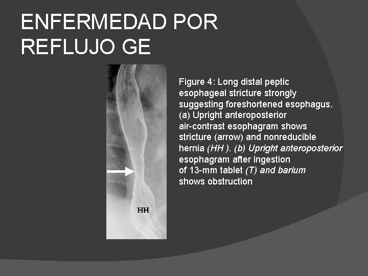 ENFERMEDAD POR REFLUJO GE Figure 4: Long distal peptic esophageal stricture strongly suggesting foreshortened