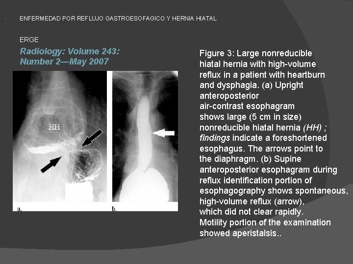  ENFERMEDAD POR REFLUJO GASTROESOFAGICO Y HERNIA HIATAL ERGE Radiology: Volume 243: Number 2—May