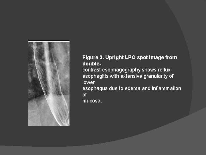 Figure 3. Upright LPO spot image from doublecontrast esophagography shows reflux esophagitis with extensive