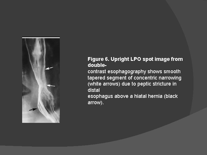 Figure 6. Upright LPO spot image from doublecontrast esophagography shows smooth tapered segment of