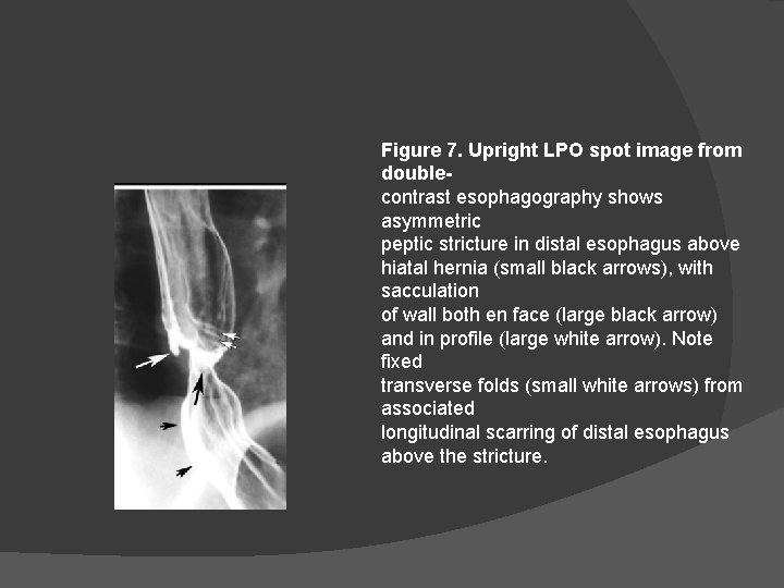 Figure 7. Upright LPO spot image from doublecontrast esophagography shows asymmetric peptic stricture in