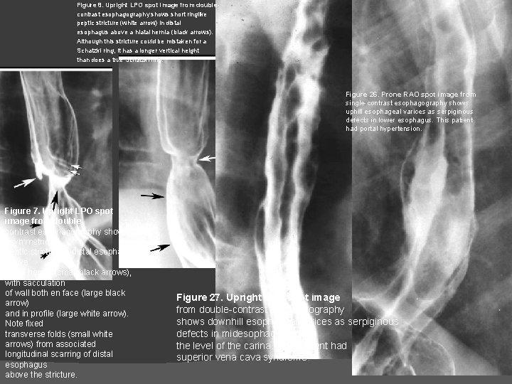 Figure 8. Upright LPO spot image from doublecontrast esophagography shows short ringlike peptic stricture