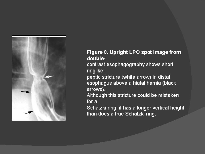 Figure 8. Upright LPO spot image from doublecontrast esophagography shows short ringlike peptic stricture