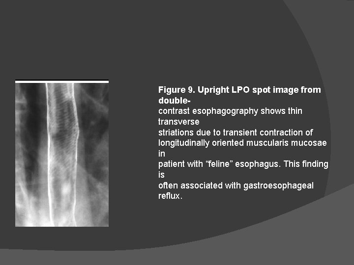 Figure 9. Upright LPO spot image from doublecontrast esophagography shows thin transverse striations due