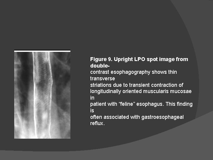 Figure 9. Upright LPO spot image from doublecontrast esophagography shows thin transverse striations due