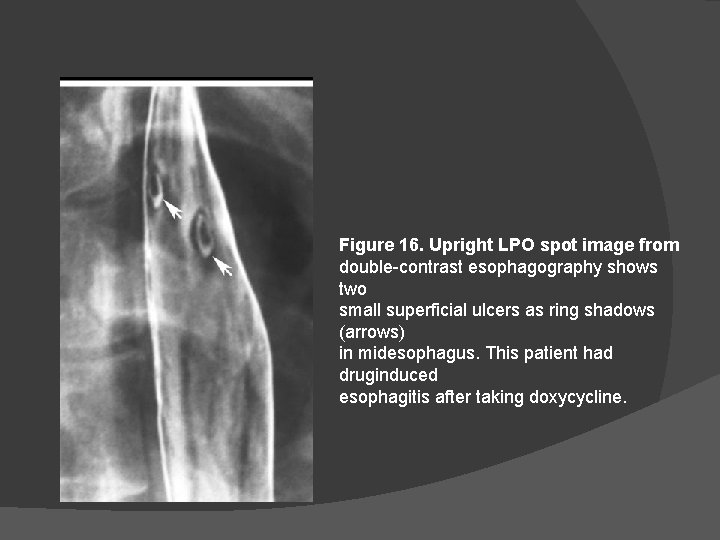 Figure 16. Upright LPO spot image from double-contrast esophagography shows two small superficial ulcers