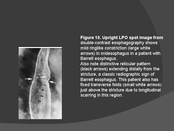 Figure 10. Upright LPO spot image from double-contrast esophagography shows mild ringlike constriction (large