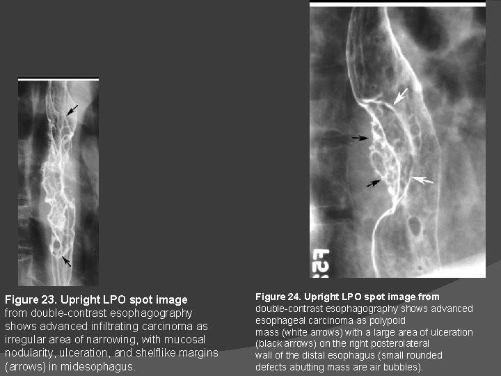 Figure 23. Upright LPO spot image from double-contrast esophagography shows advanced infiltrating carcinoma as