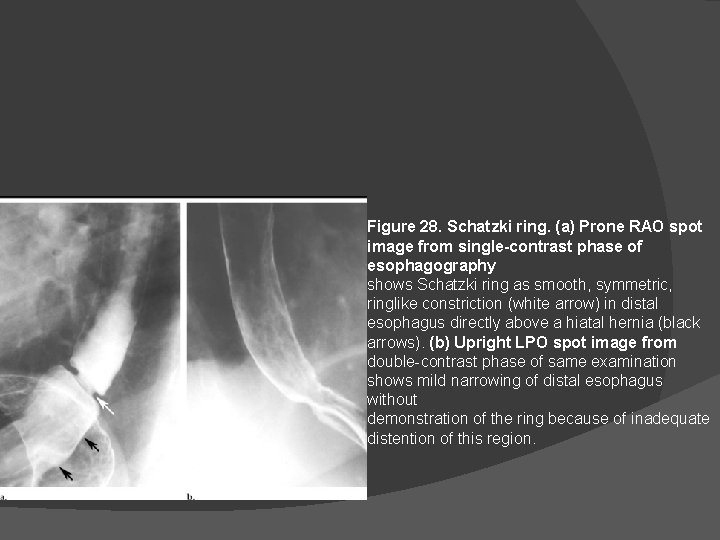 Figure 28. Schatzki ring. (a) Prone RAO spot image from single-contrast phase of esophagography