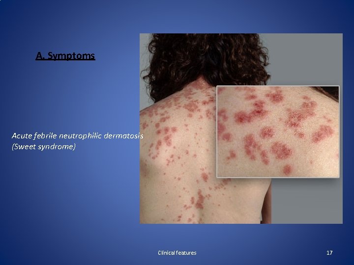 A. Symptoms Acute febrile neutrophilic dermatosis (Sweet syndrome) Clinical features 17 