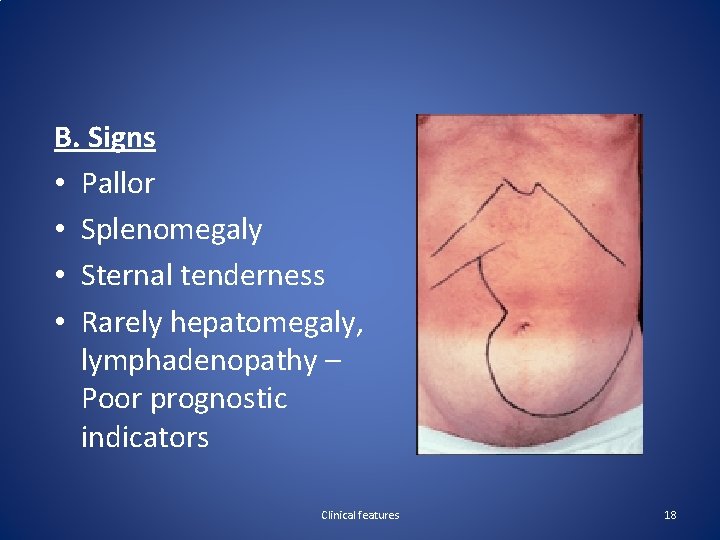 B. Signs • Pallor • Splenomegaly • Sternal tenderness • Rarely hepatomegaly, lymphadenopathy –