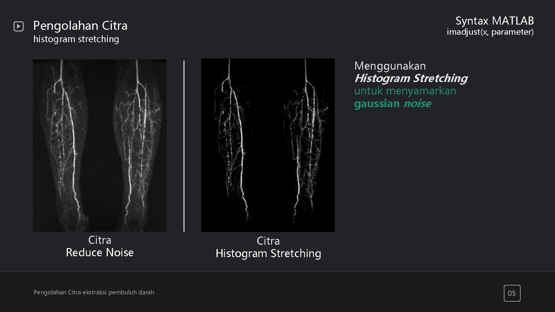 Imadjust Parameters Image Processing EKSTRAKSI PEMBULUH DARAH KELOMPOK 6 Fitra