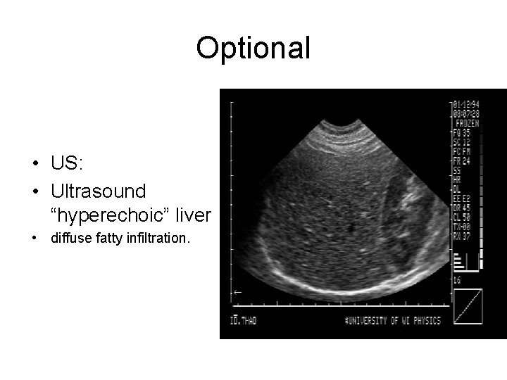 Optional • US: • Ultrasound “hyperechoic” liver • diffuse fatty infiltration. 
