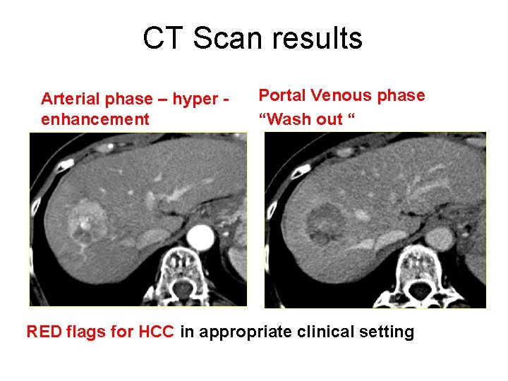 CT Scan results Arterial phase – hyper enhancement Portal Venous phase “Wash out “