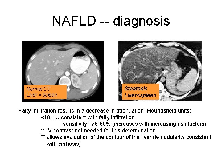 NAFLD -- diagnosis Normal CT Liver = spleen Steatosis Severe fatty infiltration; liver<spleen Liver<spleen