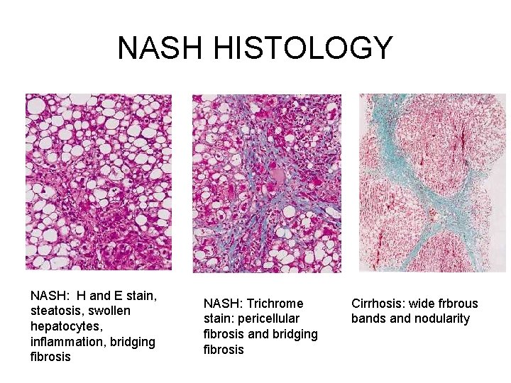 NASH HISTOLOGY NASH: H and E stain, steatosis, swollen hepatocytes, inflammation, bridging fibrosis NASH: