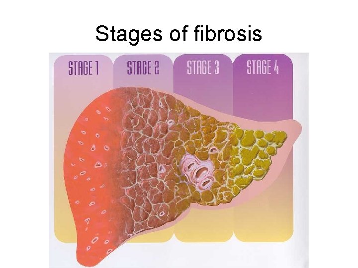 Stages of fibrosis 