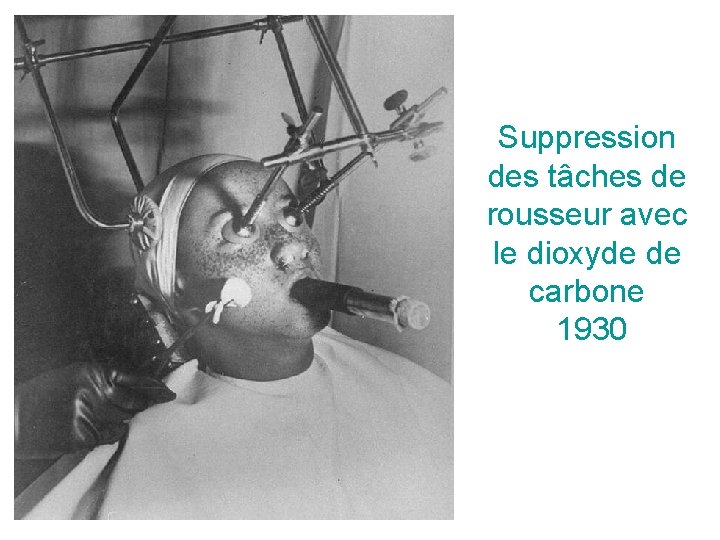 Suppression des tâches de rousseur avec le dioxyde de carbone 1930 