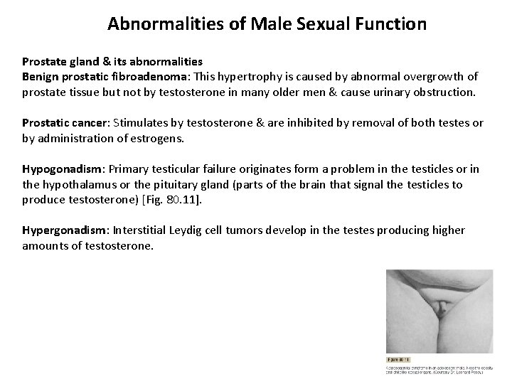 Abnormalities of Male Sexual Function Prostate gland & its abnormalities Benign prostatic fibroadenoma: This