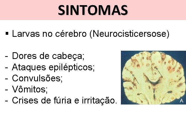 SINTOMAS § Larvas no cérebro (Neurocisticersose) - Dores de cabeça; Ataques epilépticos; Convulsões; Vômitos;