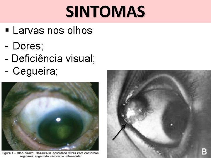 SINTOMAS § Larvas nos olhos - Dores; - Deficiência visual; - Cegueira; 