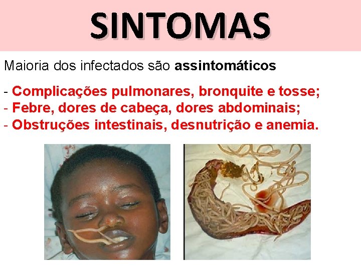 SINTOMAS Maioria dos infectados são assintomáticos - Complicações pulmonares, bronquite e tosse; - Febre,