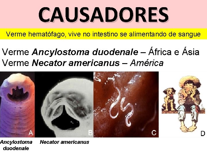 CAUSADORES Verme hematófago, vive no intestino se alimentando de sangue Verme Ancylostoma duodenale –