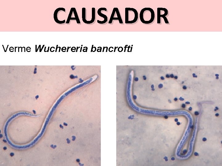 CAUSADOR Verme Wuchereria bancrofti 