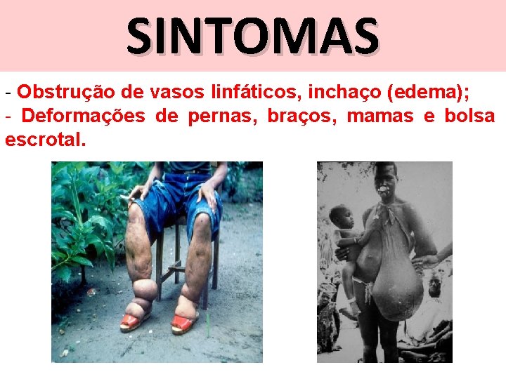 SINTOMAS - Obstrução de vasos linfáticos, inchaço (edema); - Deformações de pernas, braços, mamas