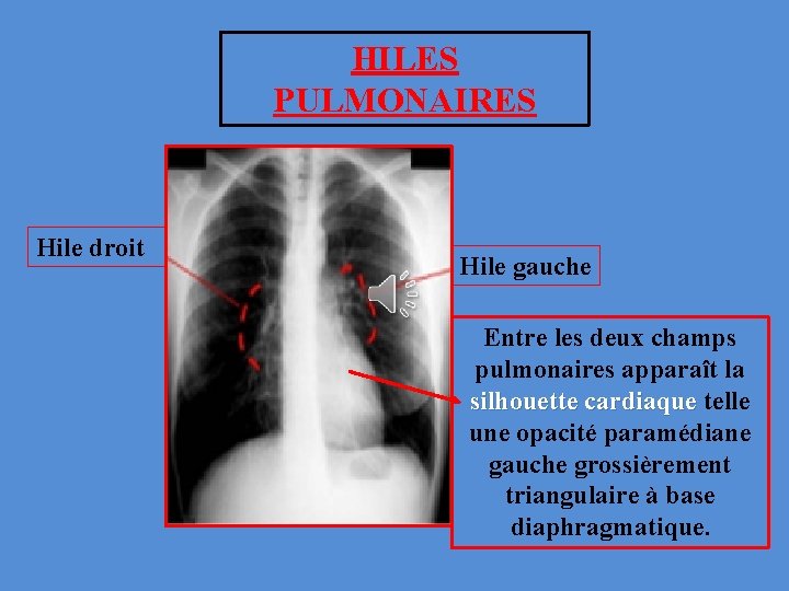 HILES PULMONAIRES Hile droit Hile gauche Entre les deux champs pulmonaires apparaît la silhouette