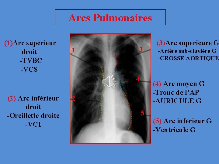 Arcs Pulmonaires (1)Arc supérieur droit -TVBC -VCS 1 3 4 (2) Arc inférieur droit