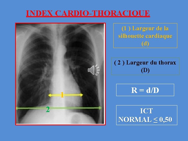 INDEX CARDIO-THORACIQUE (1 ) Largeur de la silhouette cardiaque (d) ( 2 ) Largeur