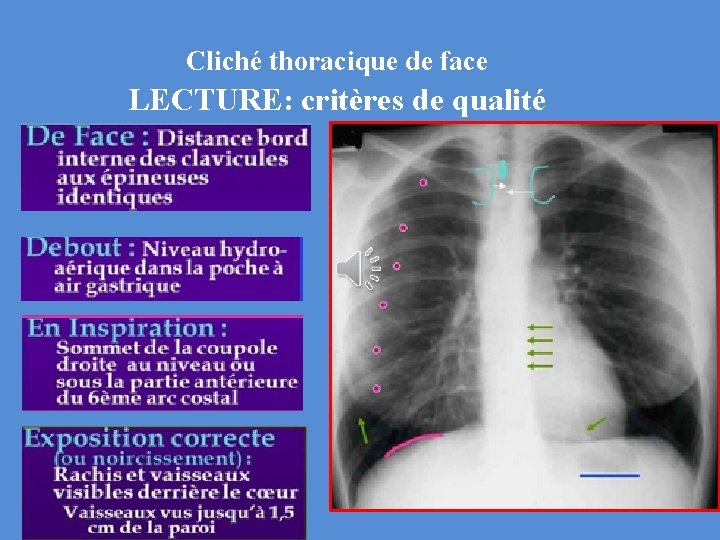 Cliché thoracique de face LECTURE: critères de qualité 