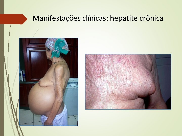 Manifestações clínicas: hepatite crônica Manifestações clínicas: hepatite crônica