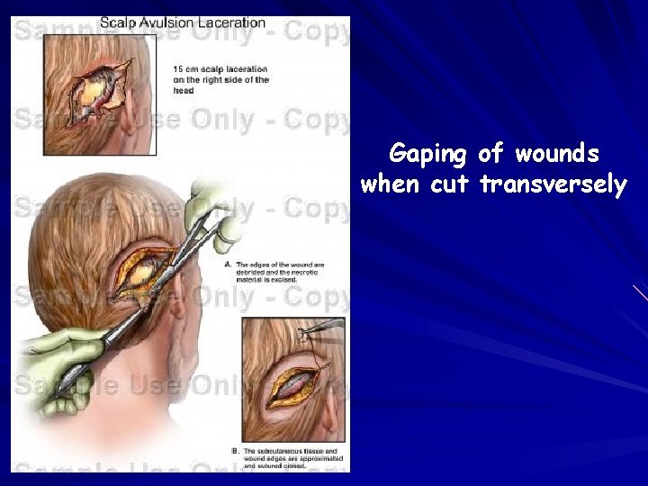 Gaping of wounds when cut transversely 
