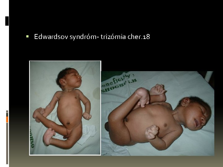  Edwardsov syndróm- trizómia cher. 18 