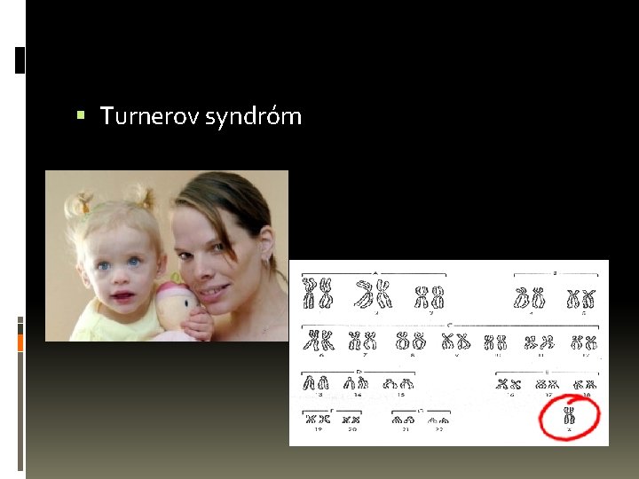  Turnerov syndróm 