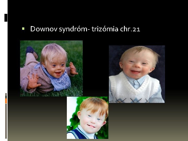  Downov syndróm- trizómia chr. 21 