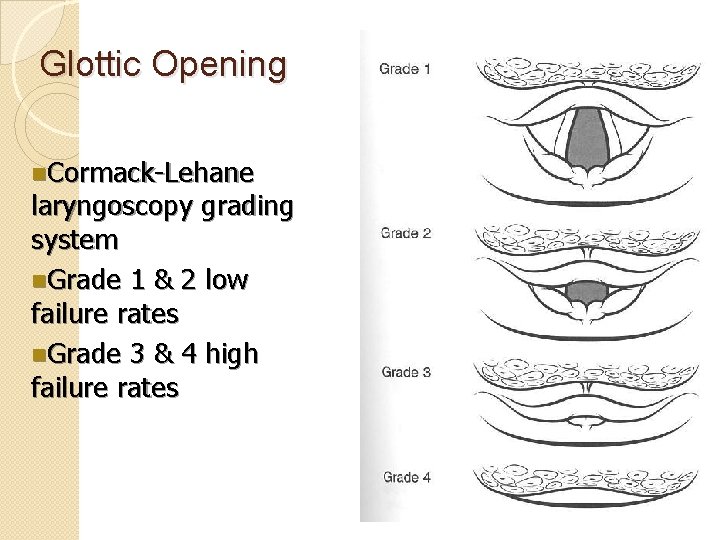 Glottic Opening n. Cormack-Lehane laryngoscopy grading system n. Grade 1 & 2 low failure