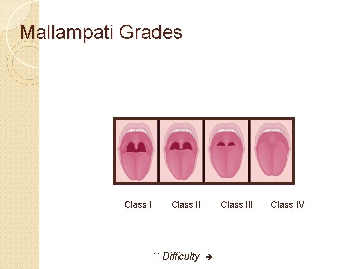 Mallampati Grades Class II Difficulty Class III Class IV 