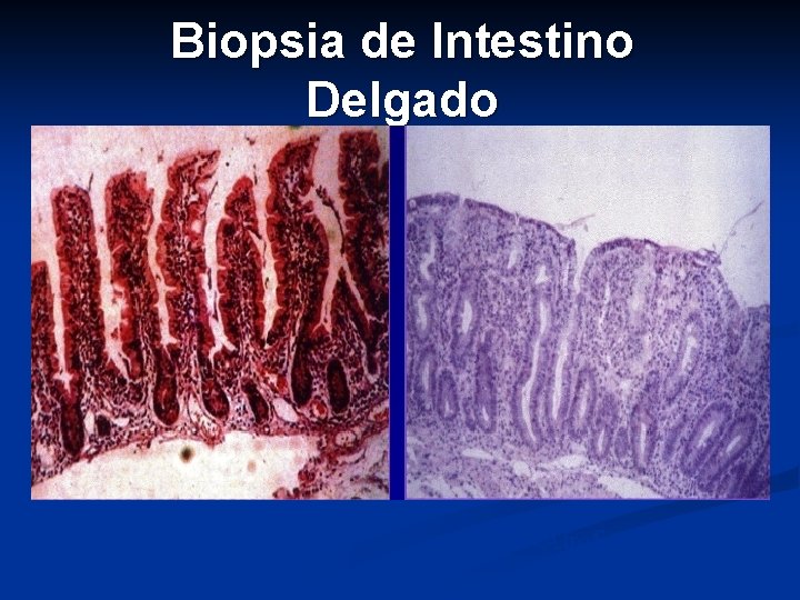 Biopsia de Intestino Delgado Normal Atrofia 