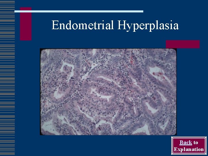 Endometrial Hyperplasia Back to Explanation 