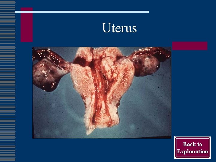 Uterus Back to Explanation 