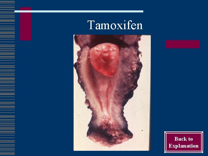 Tamoxifen Back to Explanation 