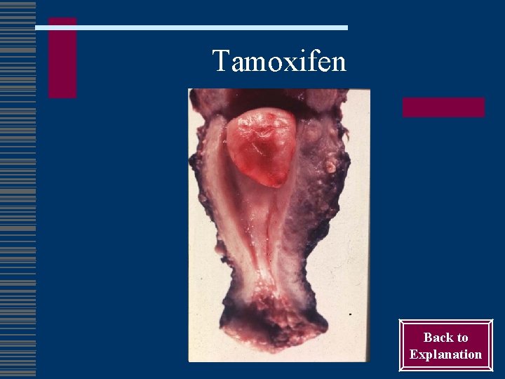 Tamoxifen Back to Explanation 