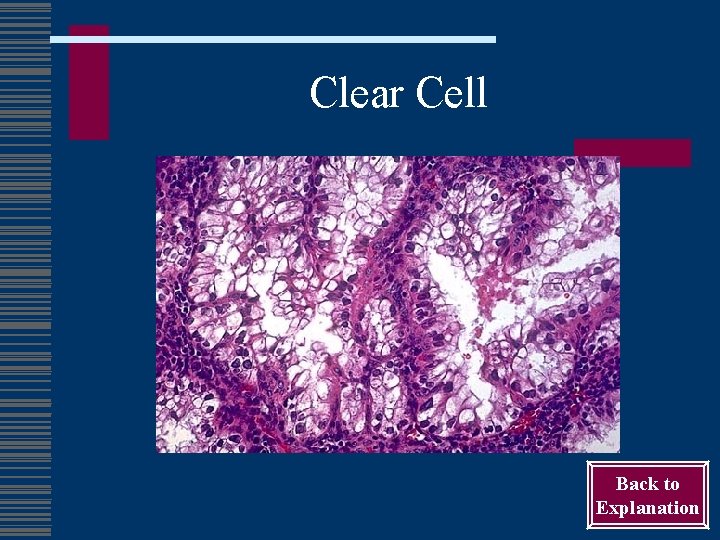 Clear Cell Back to Explanation 