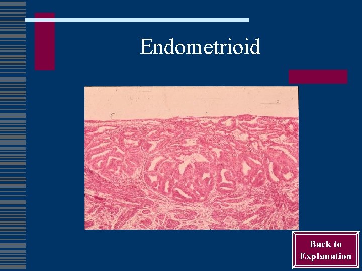 Endometrioid Back to Explanation 