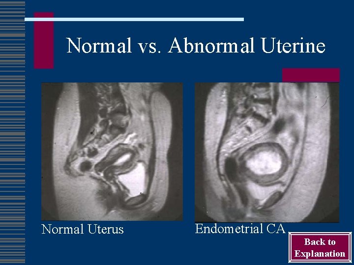 Normal vs. Abnormal Uterine Normal Uterus Endometrial CA Back to Explanation 